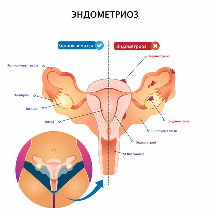 Как глисты влияют на менструацию